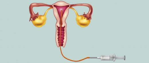 Colocar la muestra seminal