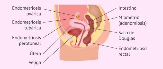 Endometriosis: tejido endometrial fuera del útero