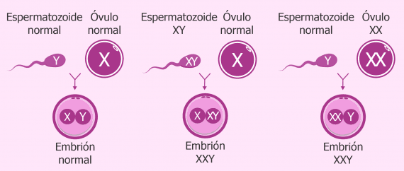 Causas de la trisomía XXY