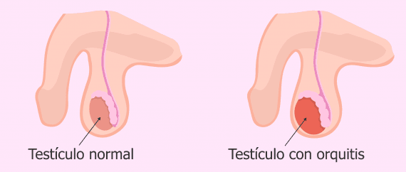 Orquitis testicular