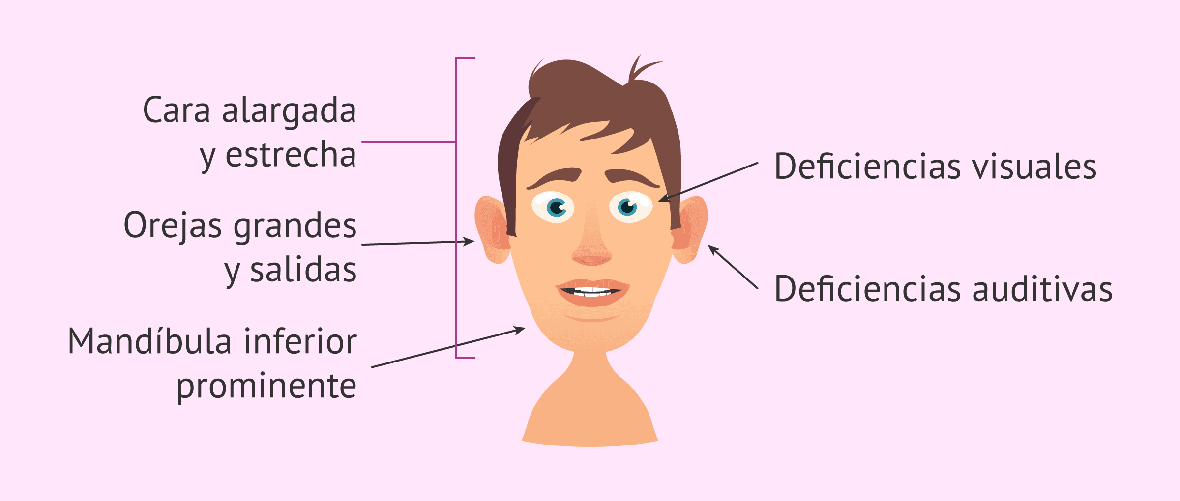 X-frágil: rasgos faciales